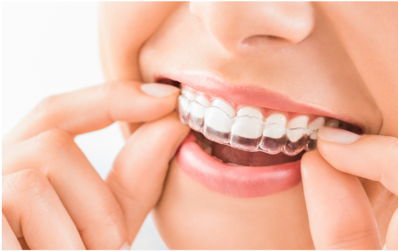 ClearCorrect invisible braces