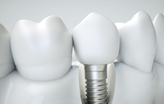 img-featured-implants